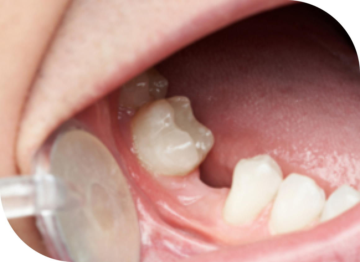 Replacement of Missing Teeth